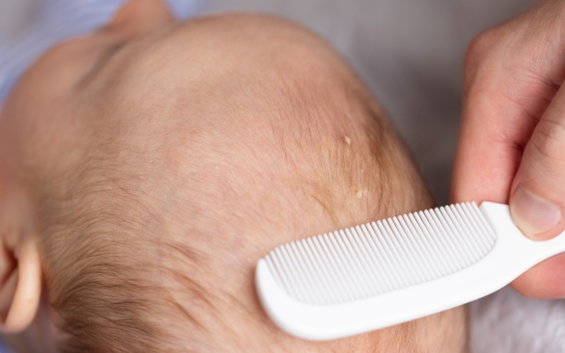 How to Treat Cradle Cap Long-Term