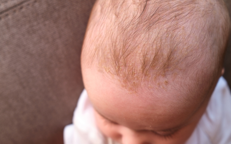How to Treat Cradle Cap with the Right Products