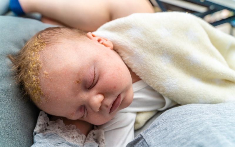 Prevent and Treat Cradle Cap