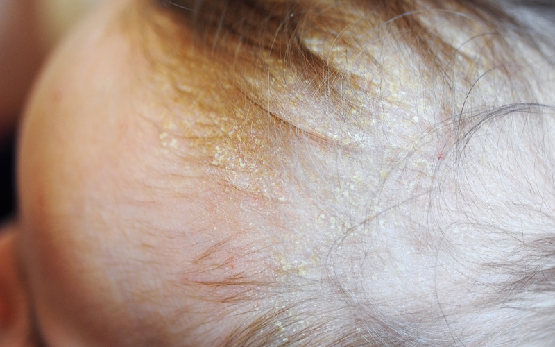 What is Cradle Cap?