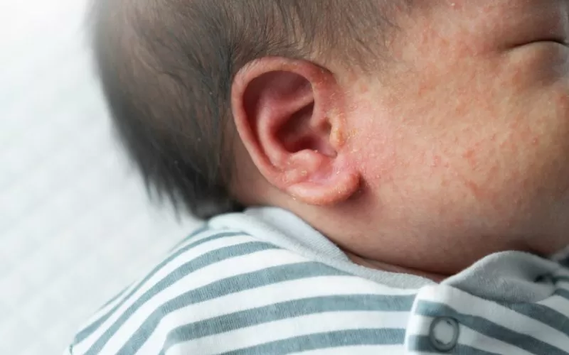 Dealing with Common Baby Skin Conditions