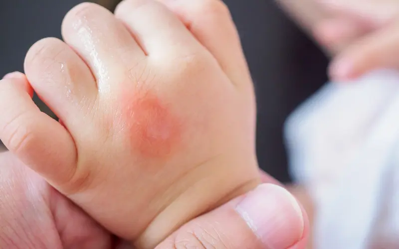 How to Deal with Baby Eczema Naturally