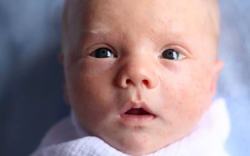 How to Get Rid of Baby Acne: Simple Care Tips