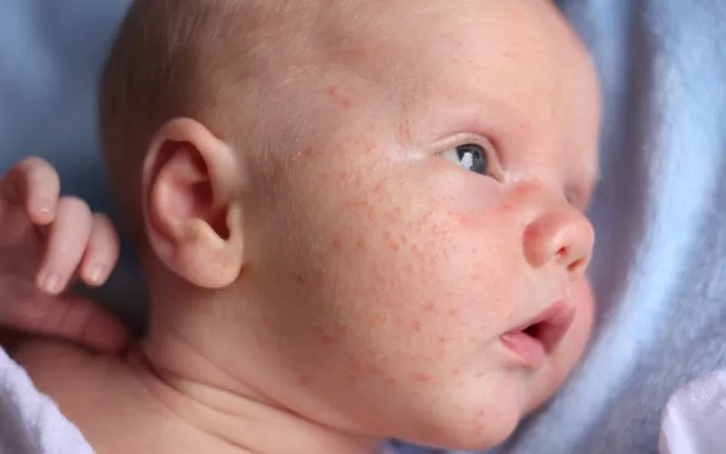 How to Identify Baby Acne vs. a Rash