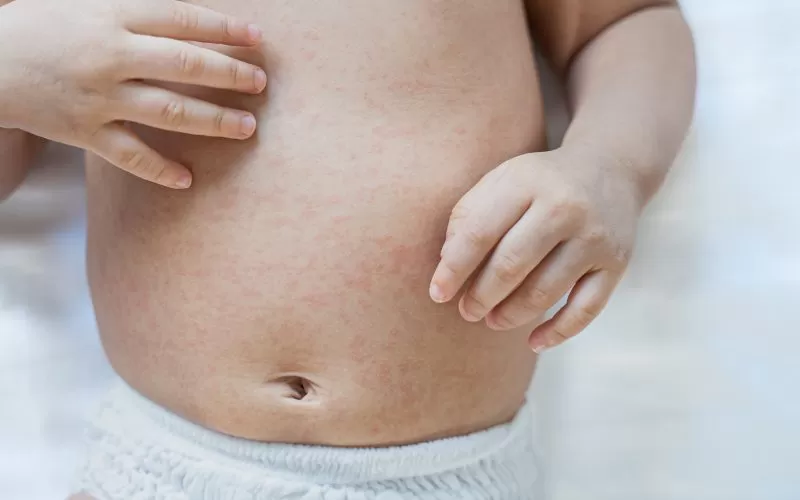 Managing Skin Rashes in Babies