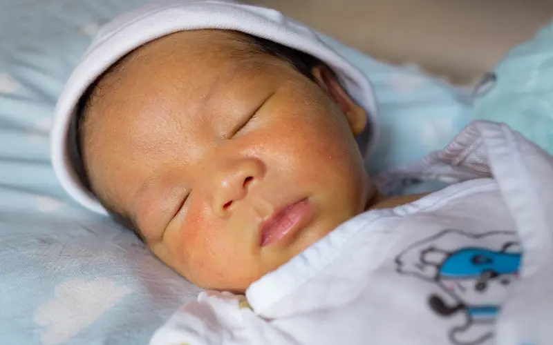 Symptoms of Jaundice in Newborns