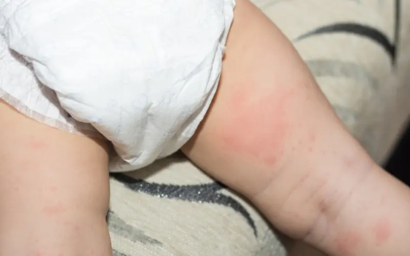 Understanding Diaper Rash: Prevention and Treatment