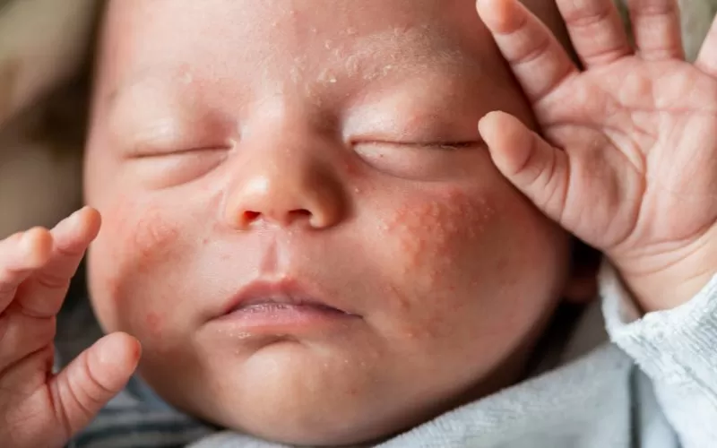 What is Baby Acne?