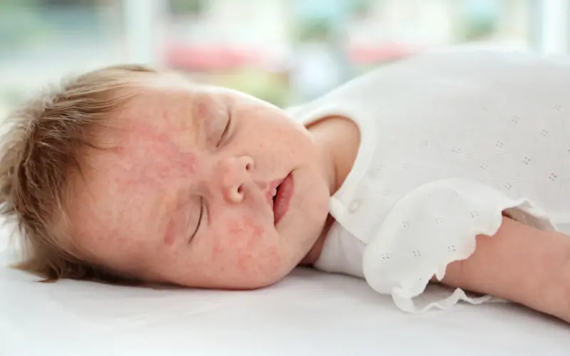 What is Baby Eczema and What Causes It?