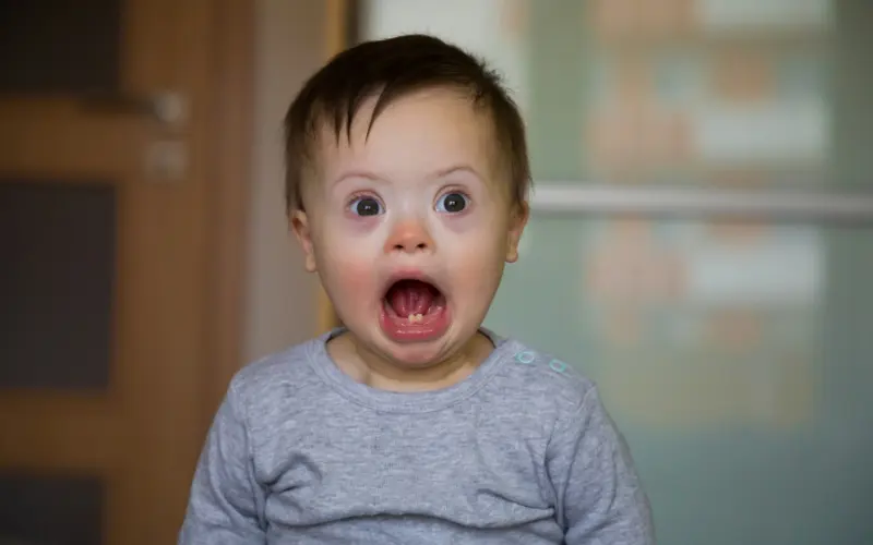 What is Flat Head Syndrome (Positional Plagiocephaly)?